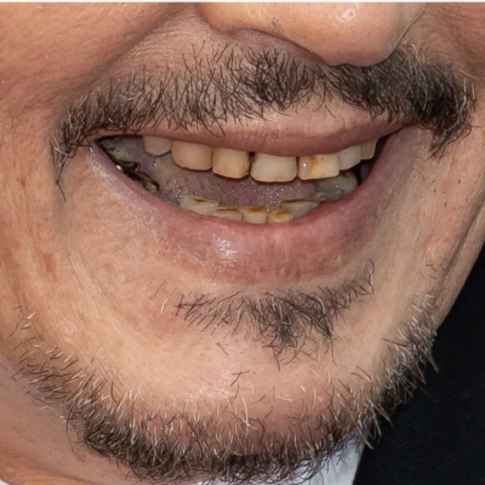 Johnny Depp current smile
